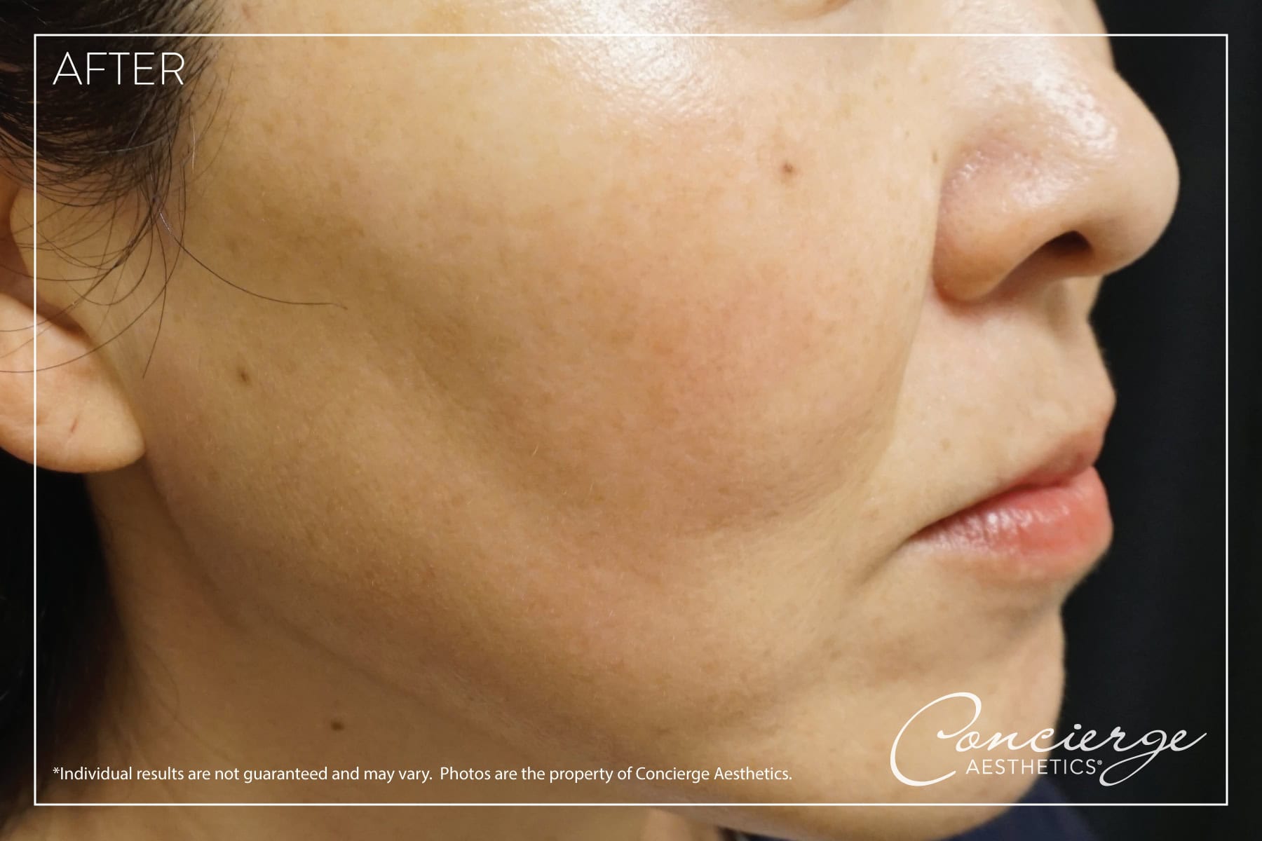 B and A Laser IPL (Facial Age/Brown Spots) Concierge Aesthetics