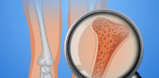 Human Bone With Osteoporosis