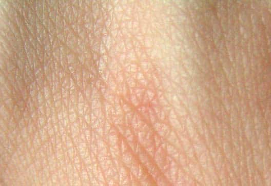 9 tips bij eczeem (je huid in balans te brengen)