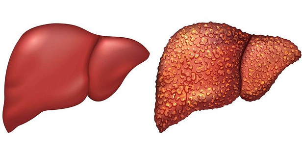 肝炎肝硬化肝癌 ：每30秒有1人因肝炎死亡 肝炎防治不能等！