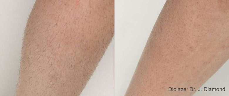 Before and after comparison of diolaze laser hair removal treatment on skin in Meridian, ID