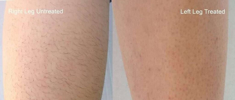 Comparison of hair removal treatment in Boise: right leg is untreated with visible hairs, left leg is treated and appears smooth.