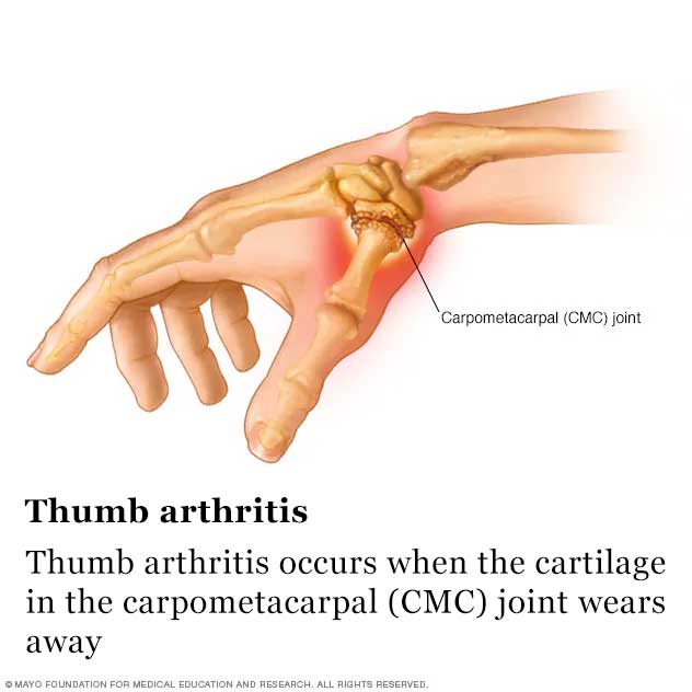 Thumb arthritis occurs when the cartilage in the carpometacarpal (CMC) joint wears away