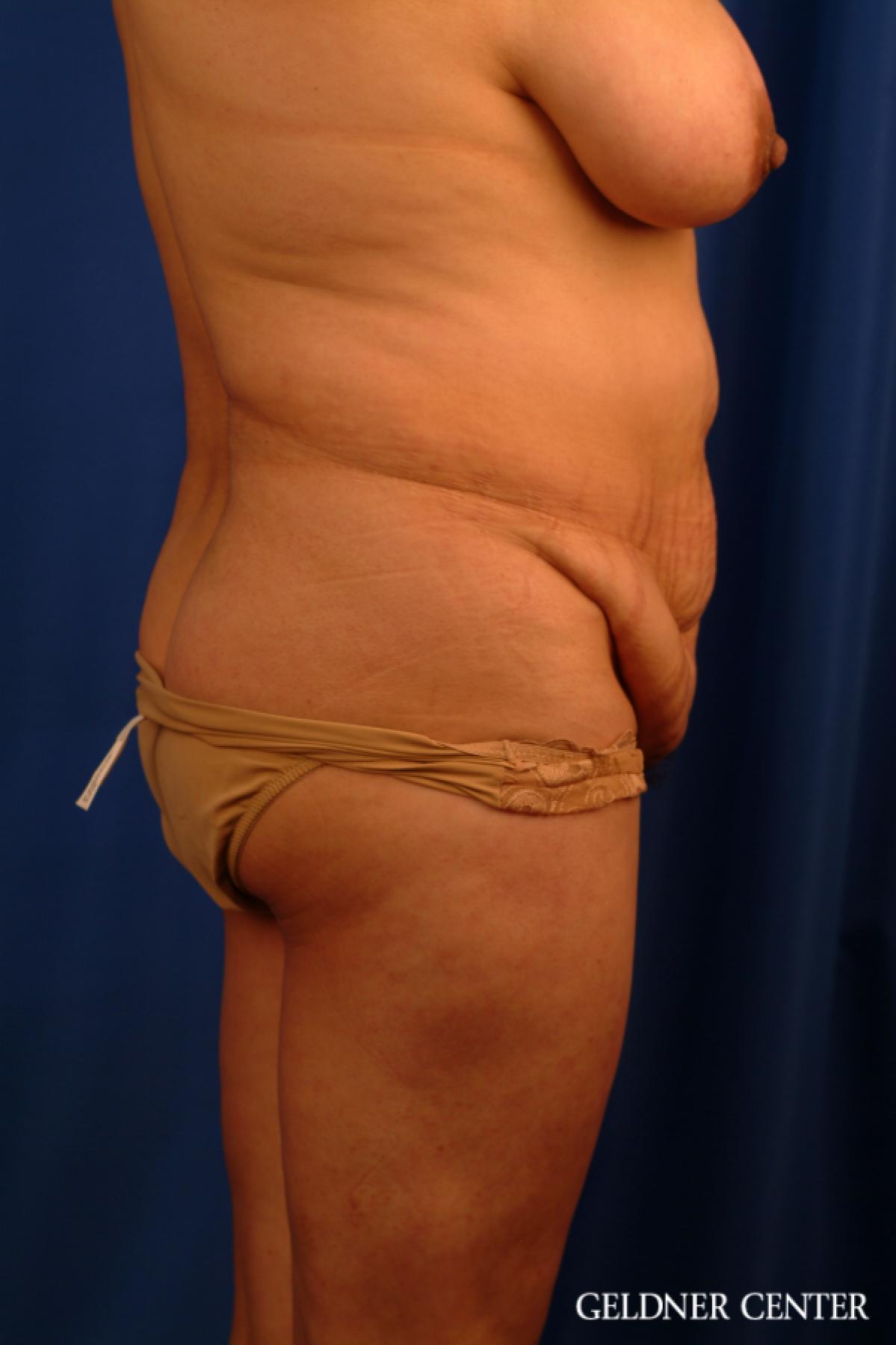 Tummy Tuck: Patient 16 - Before 3