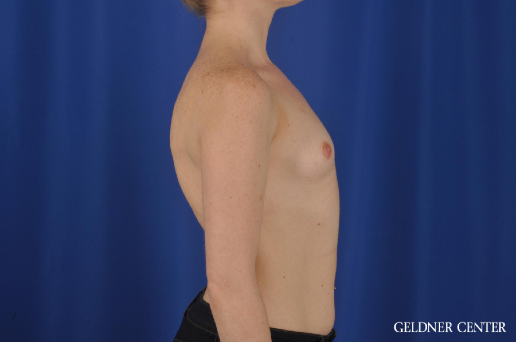 Breast Augmentation: Patient 138 - Before 2