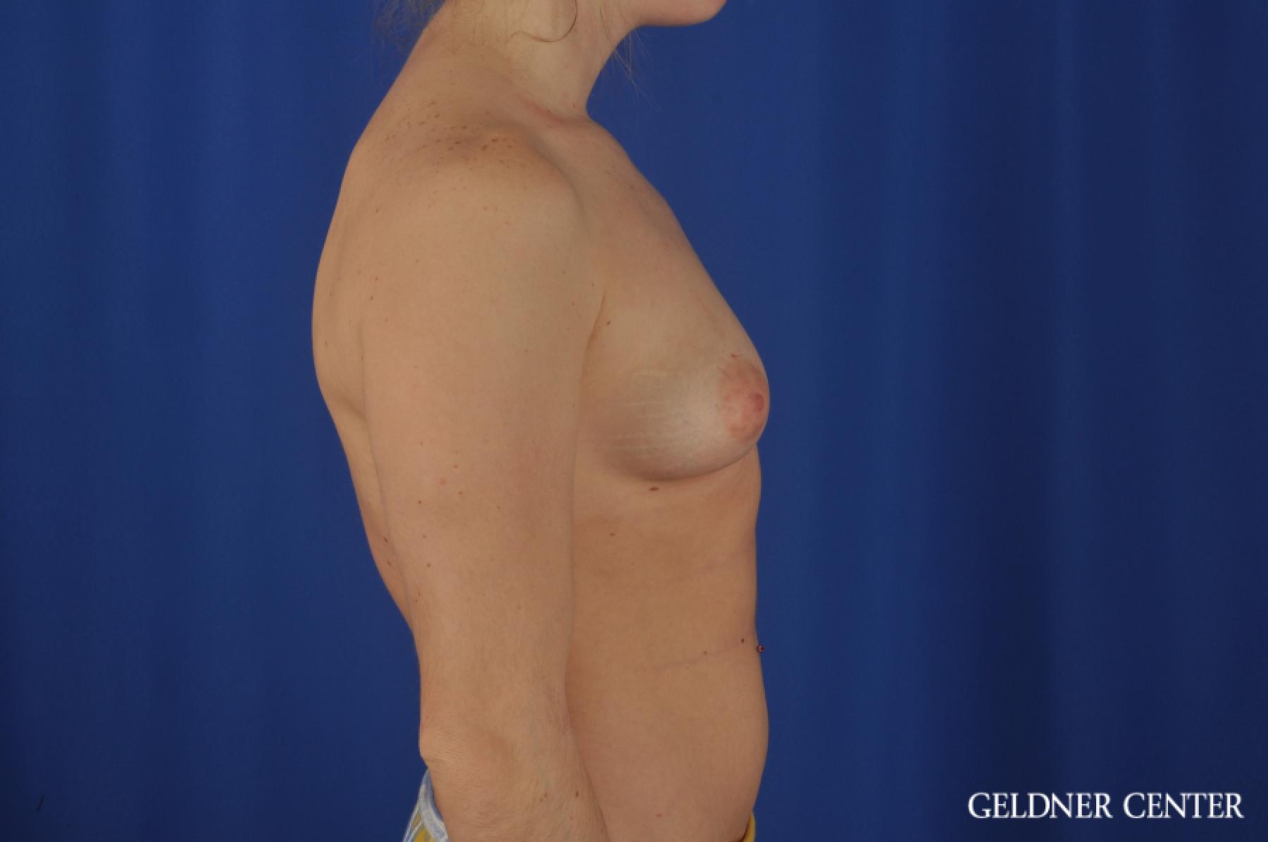 Chicago Breast Augmentation 5468 - Before 3