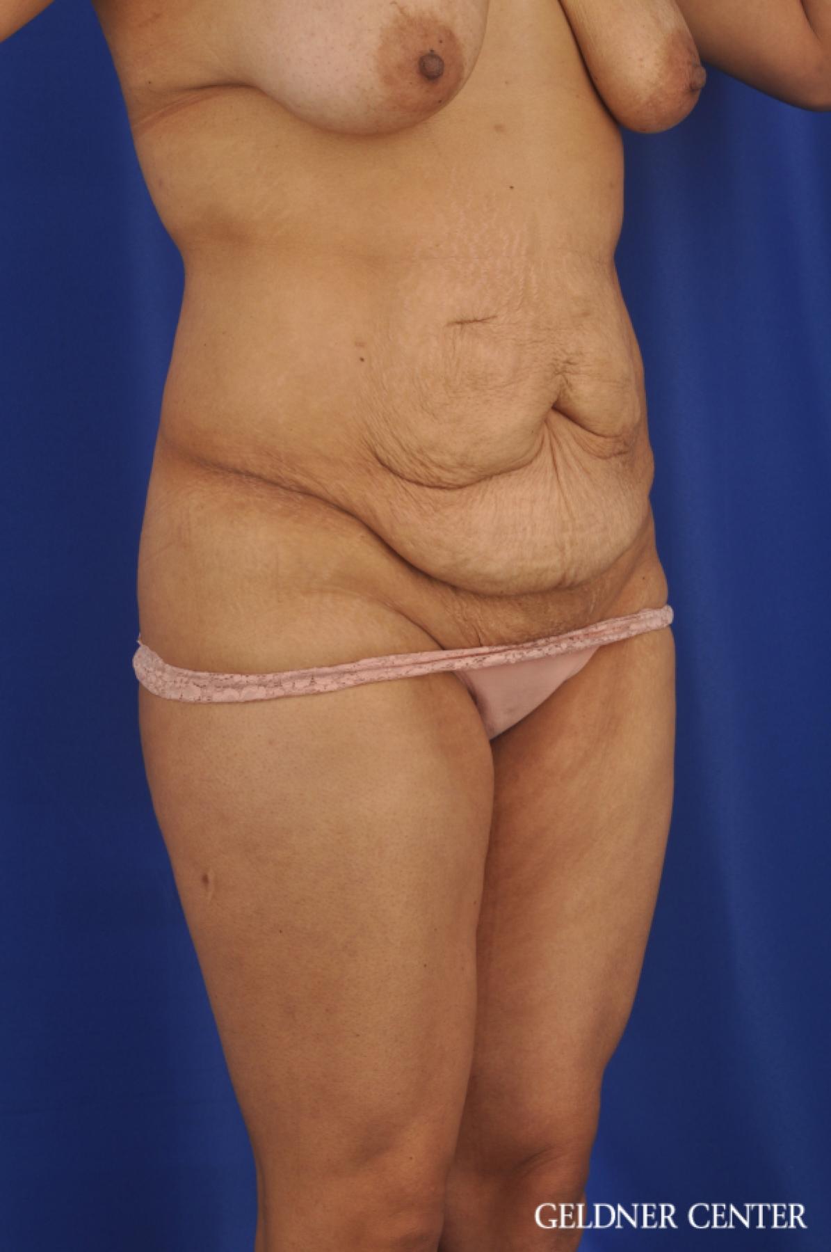 Tummy Tuck: Patient 33 - Before 2