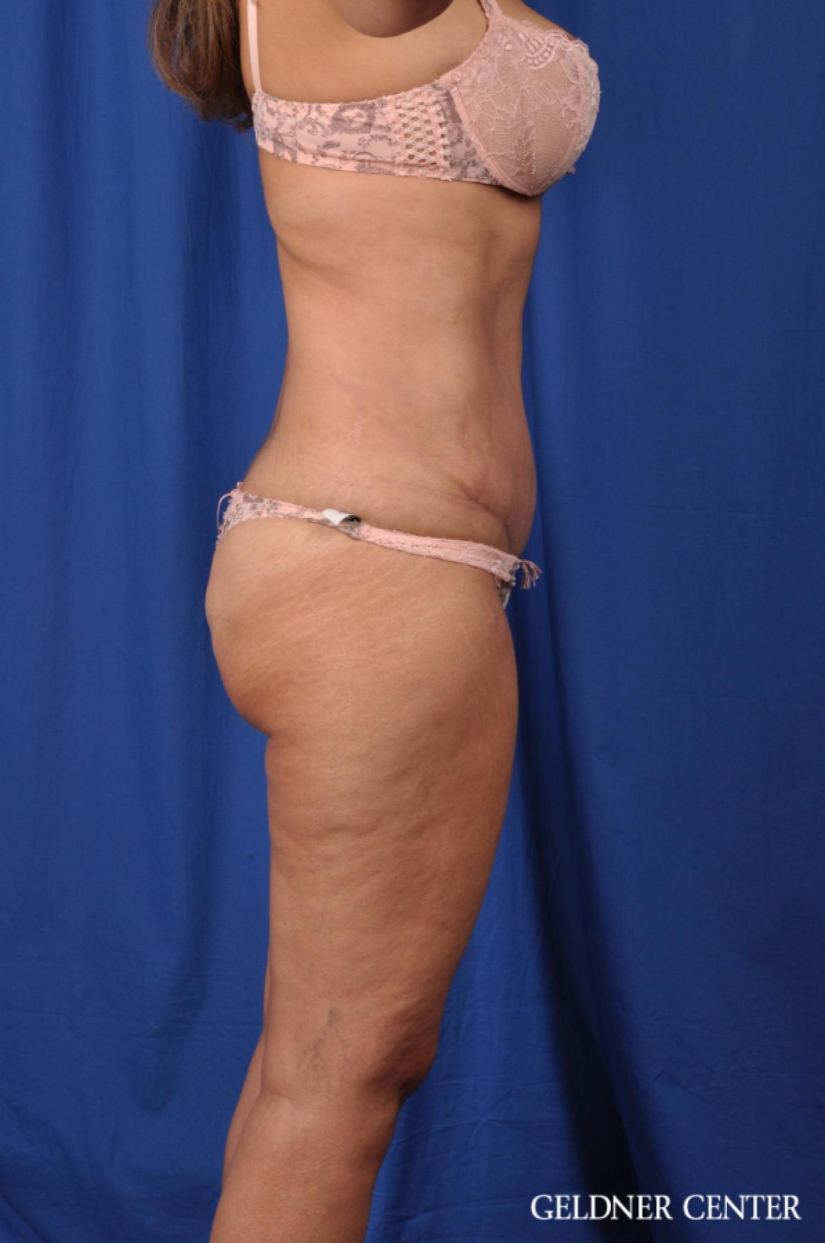 Tummy Tuck: Patient 21 - After 3