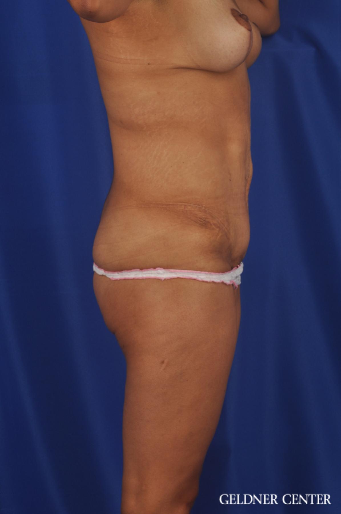 Tummy Tuck: Patient 33 - After 3
