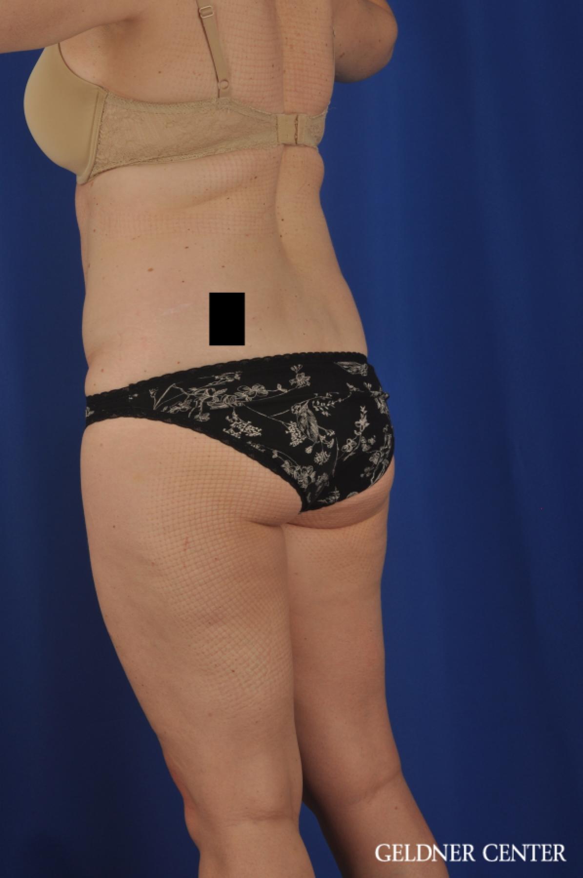 Liposuction: Patient 26 - Before and After 5