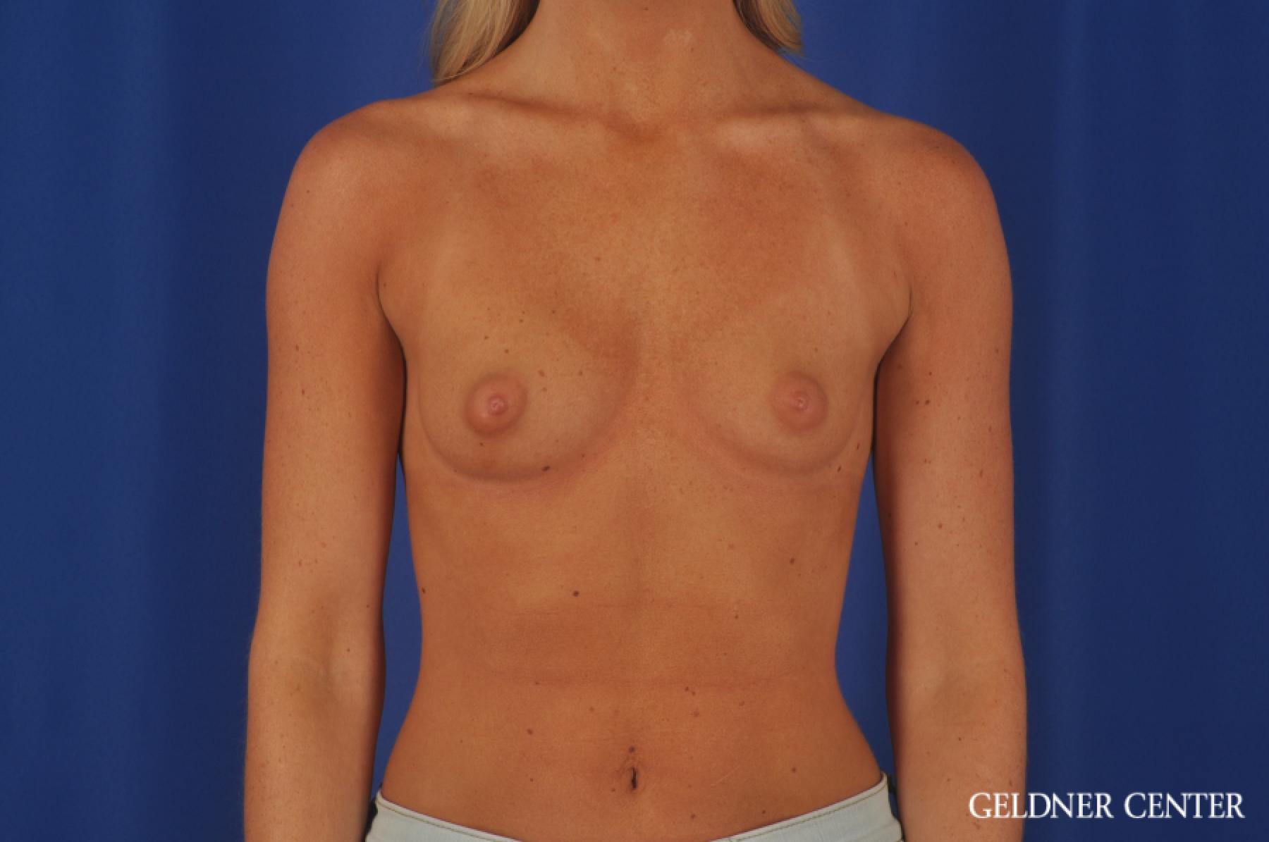 Chicago Breast Augmentation 4292 - Before 1