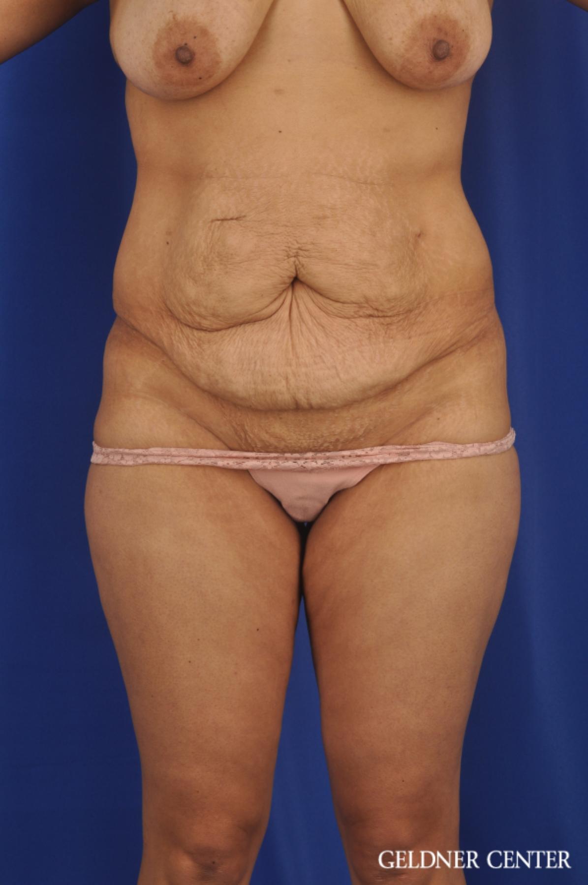 Tummy Tuck: Patient 33 - Before 1