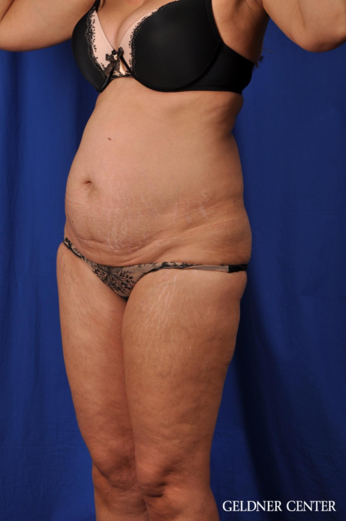 Tummy Tuck: Patient 21 - Before and After 4