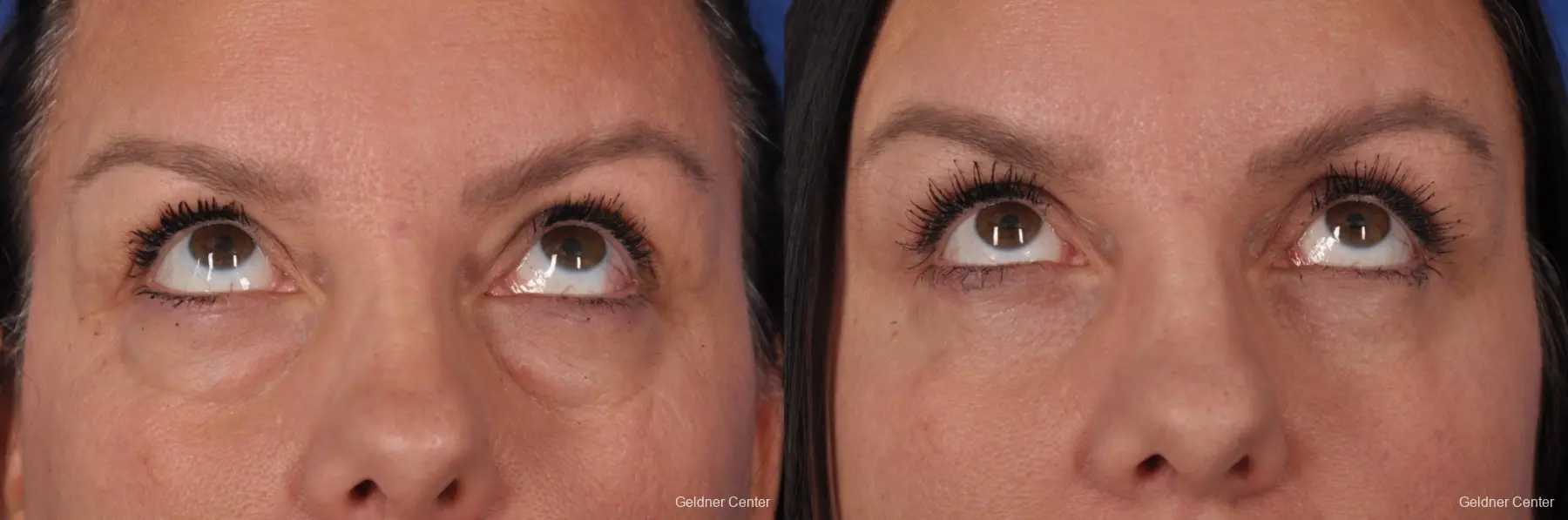 Blepharoplasty: Patient 1 - Before and After 2