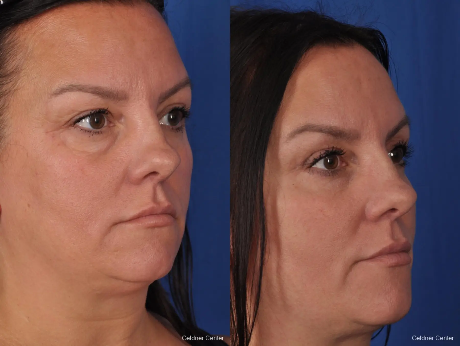 Blepharoplasty: Patient 1 - Before and After 5