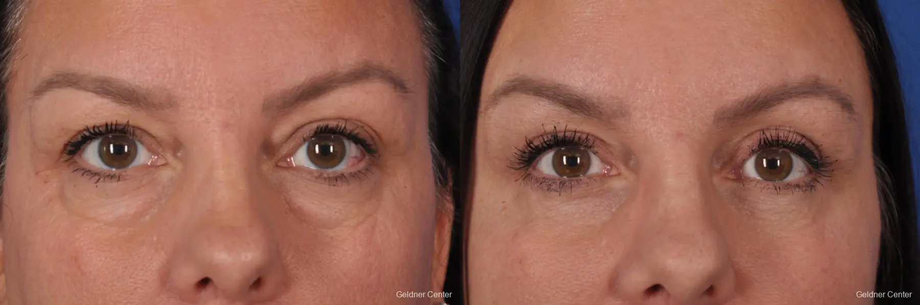 Blepharoplasty: Patient 1 - Before and After 
