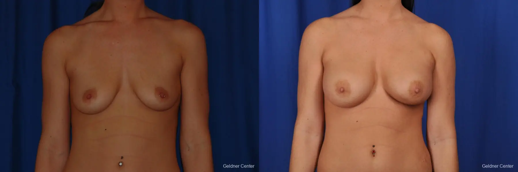 Breast Augmentation Streeterville, Chicago 2071 - Before and After
