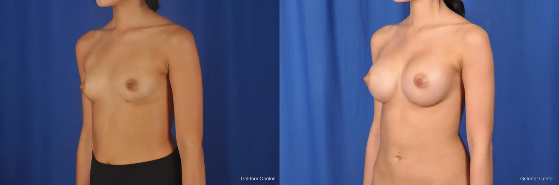 Breast Augmentation Streeterville, Chicago 8616 - Before and After 4