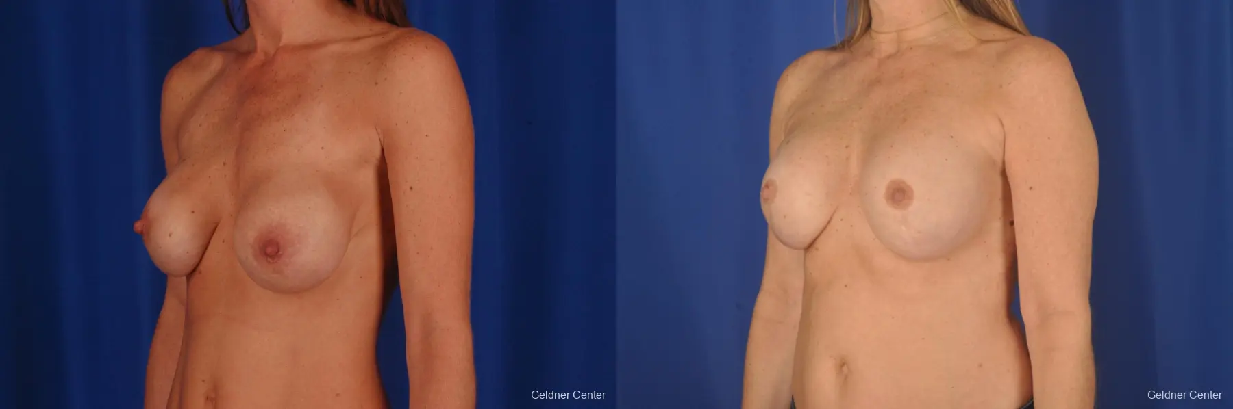 Breast Augmentation: Patient 159 - Before and After 4