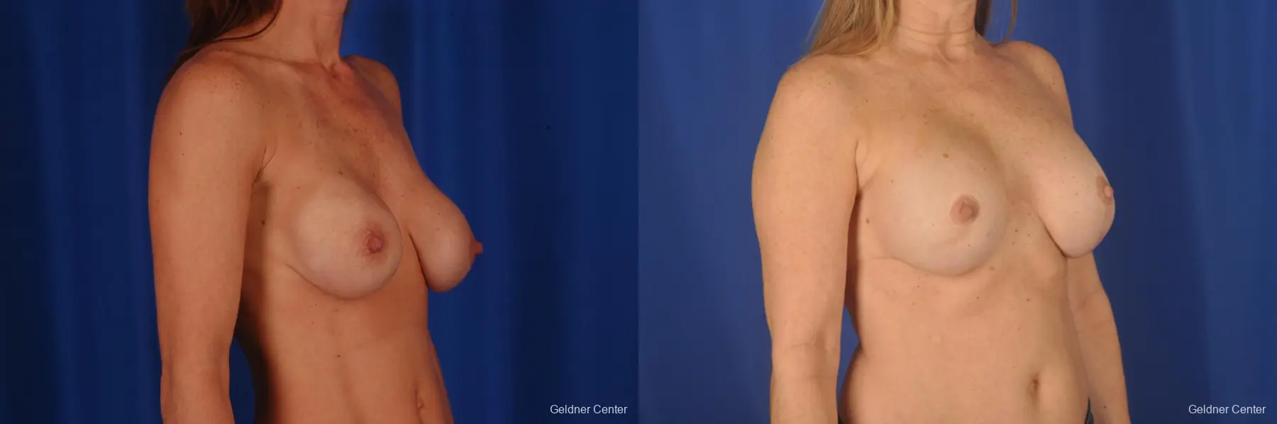 Breast Augmentation: Patient 159 - Before and After 2
