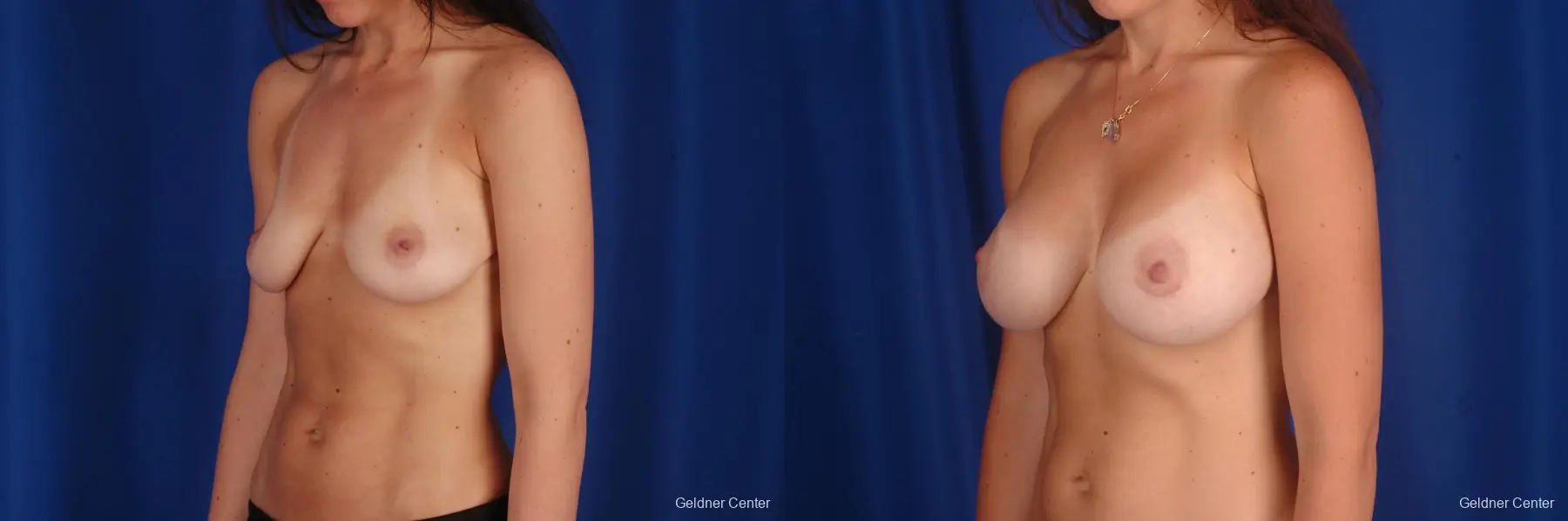 Chicago Breast Augmentation 2325 - Before and After 4