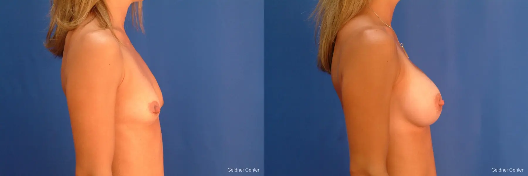 Breast Augmentation Hinsdale, Chicago 2510 - Before and After 2