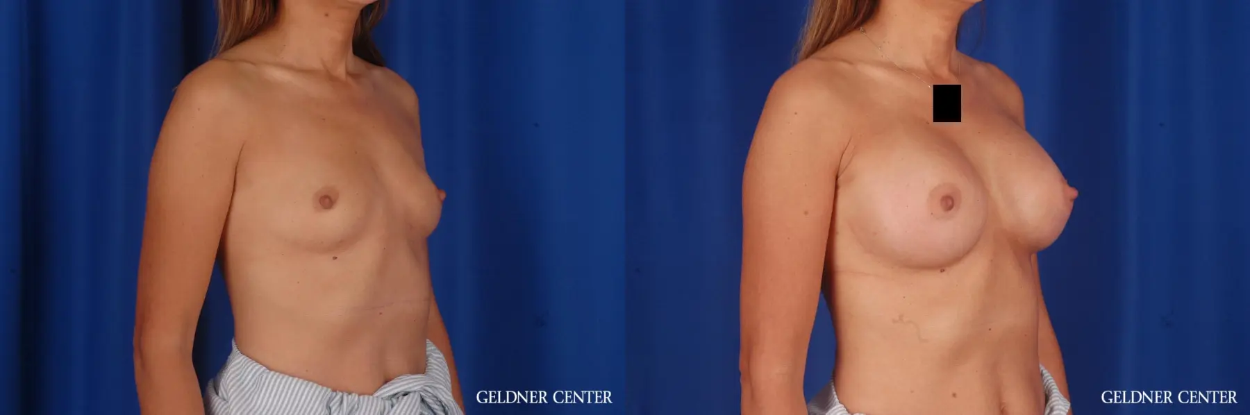 Breast Augmentation: Patient 174 - Before and After 2