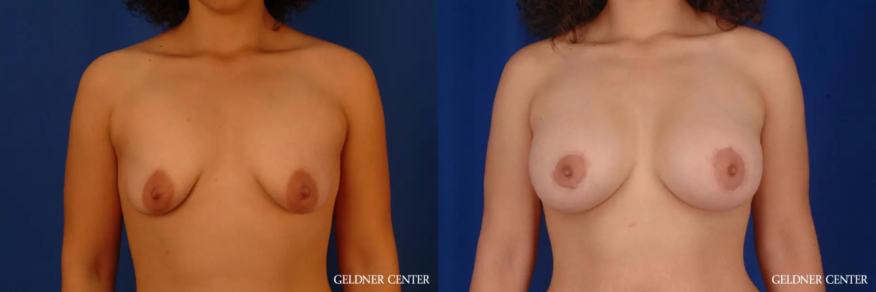 Breast Augmentation: Patient 161 - Before and After 1