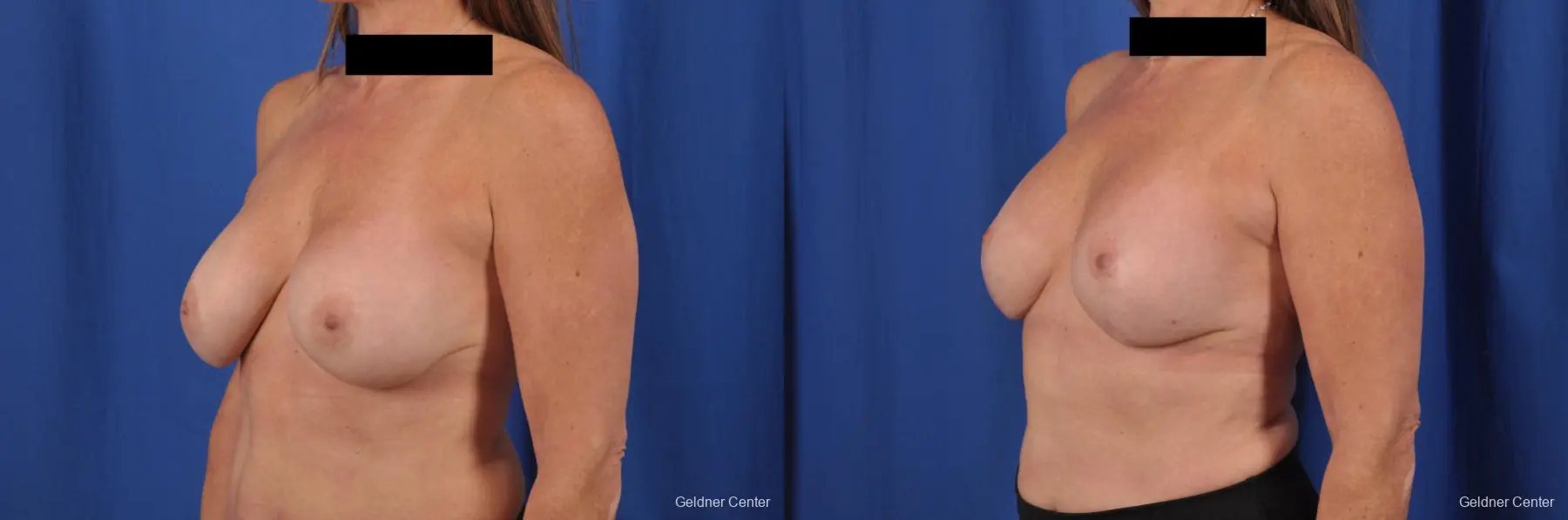 Breast Augmentation: Patient 154 - Before and After 5