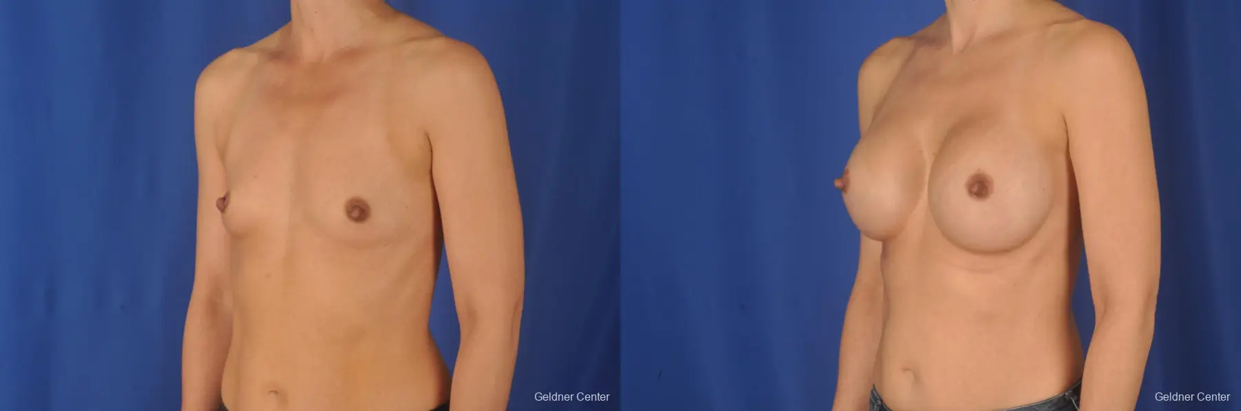 Breast Augmentation: Patient 78 - Before and After 4