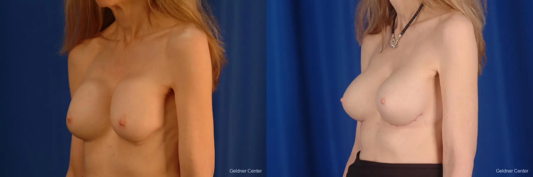 Chicago Breast Augmentation 2397 - Before and After 5