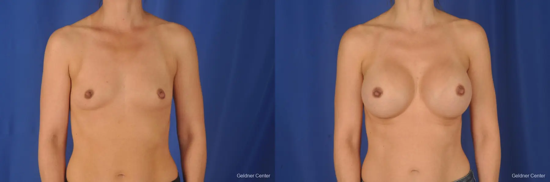 Breast Augmentation: Patient 78 - Before and After 1