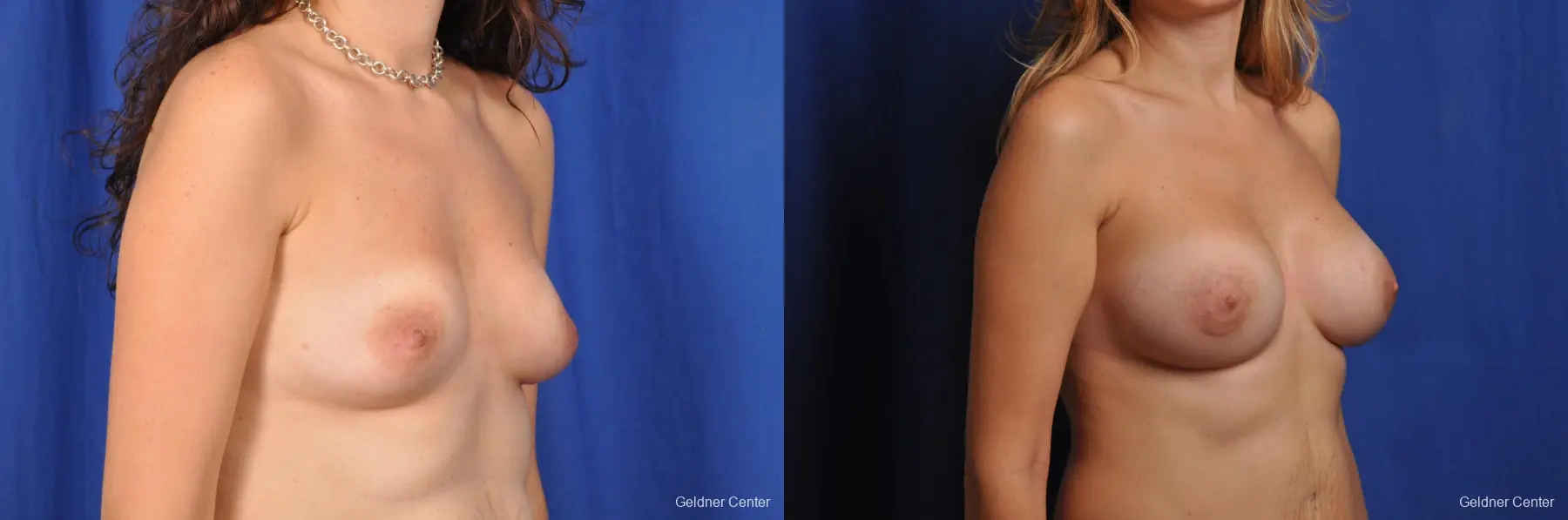 Breast Augmentation Streeterville, Chicago 2370 - Before and After 3