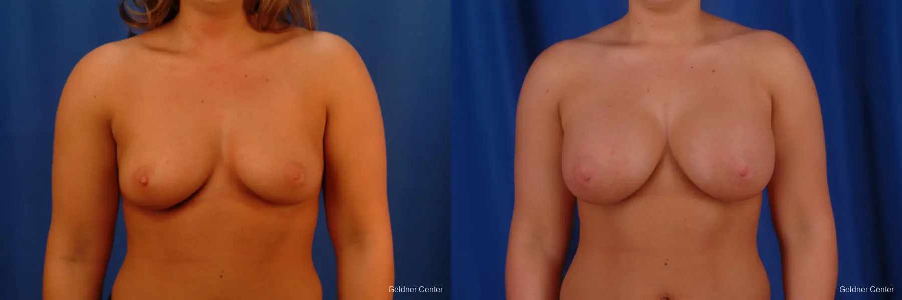 Chicago Breast Augmentation 2633 - Before and After 1