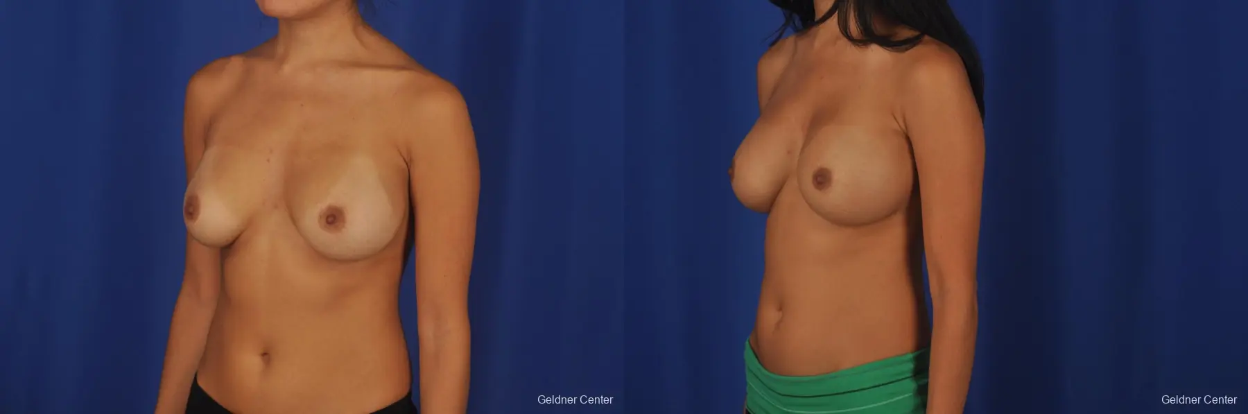 Breast Augmentation Streeterville, Chicago 2298 - Before and After 4