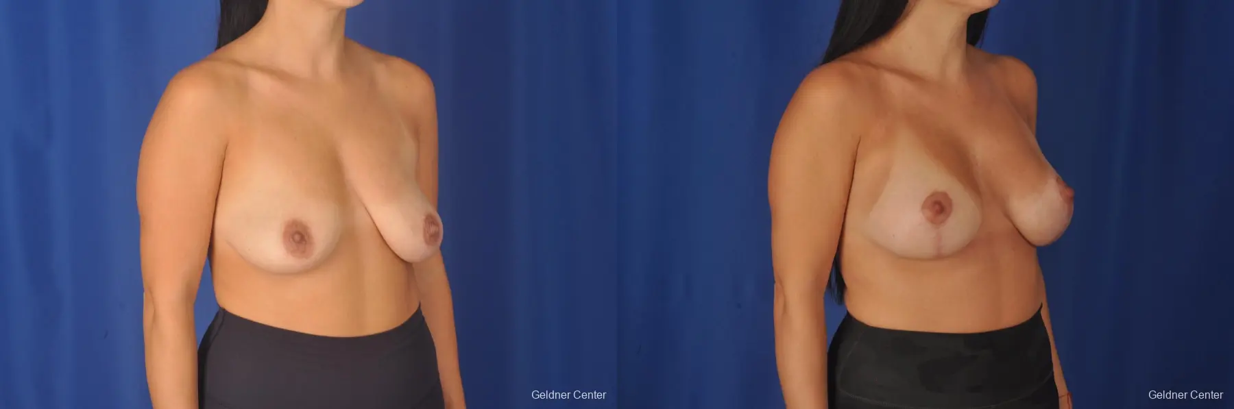 Breast Augmentation: Patient 79 - Before and After 3