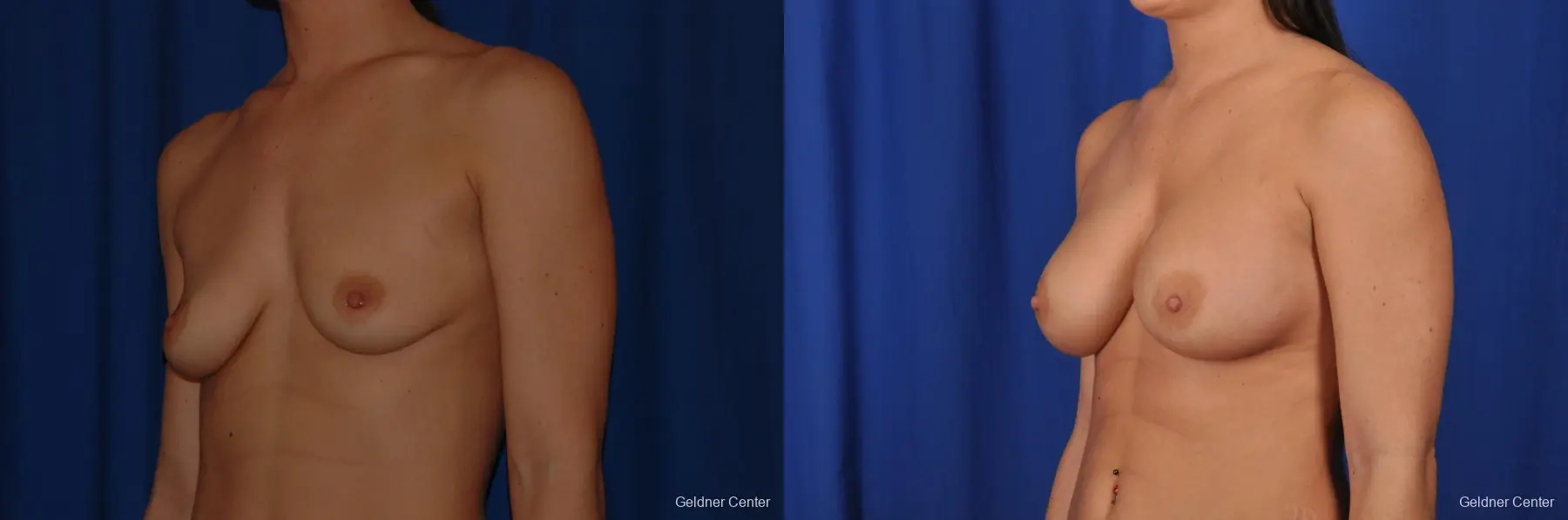 Breast Augmentation Streeterville, Chicago 2071 - Before and After 4
