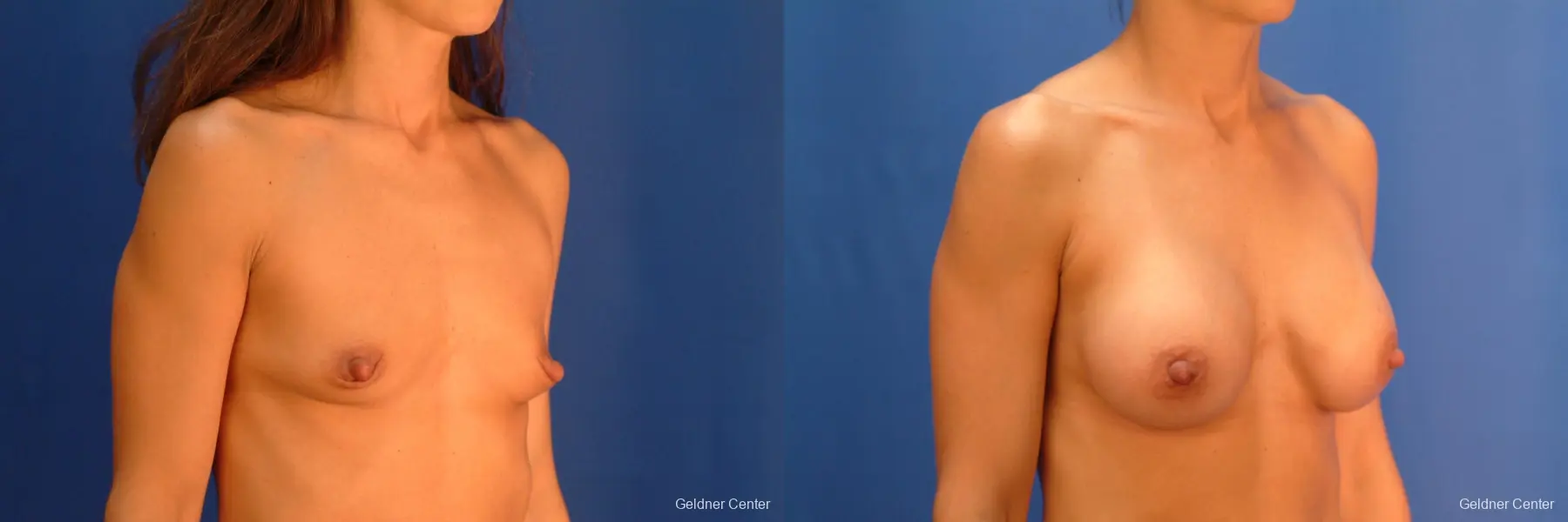 Chicago Breast Augmentation 2521 - Before and After 3
