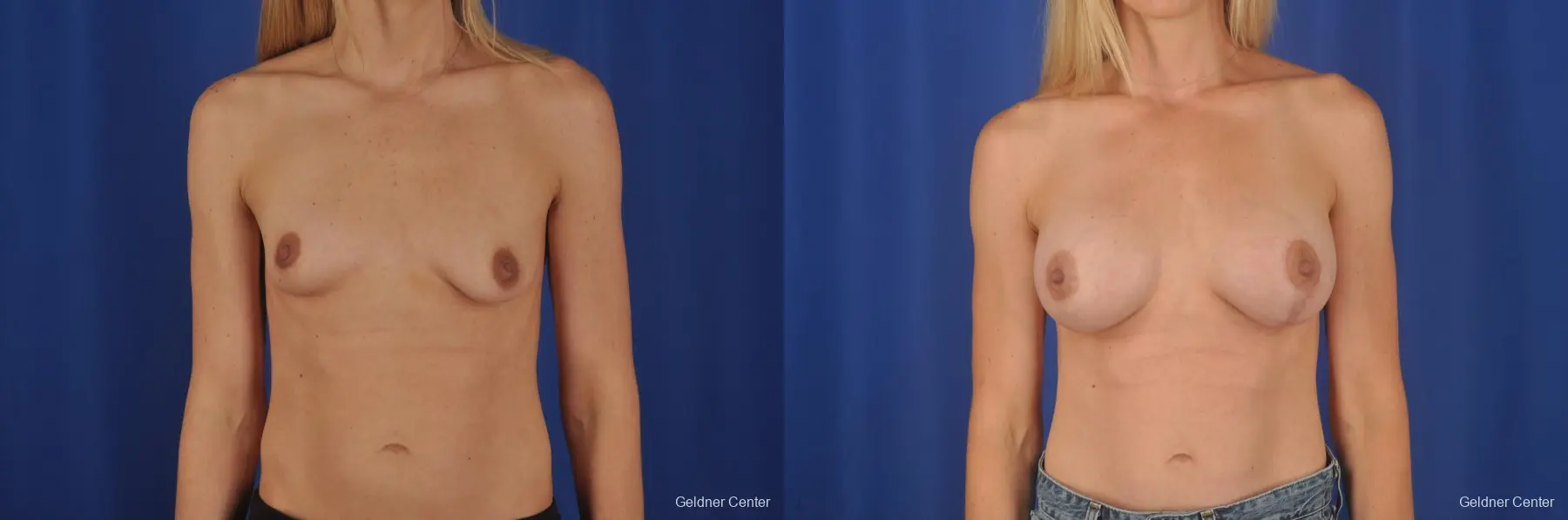 Chicago Breast Augmentation 6653 - Before and After 1