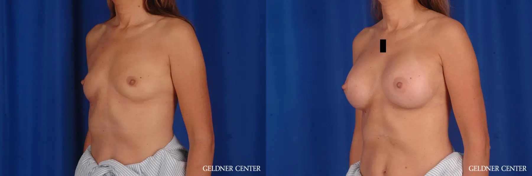Breast Augmentation: Patient 174 - Before and After 4