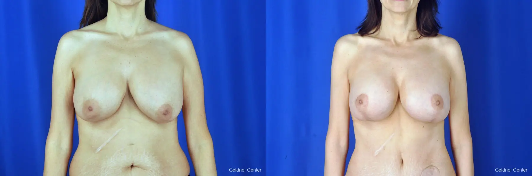 Breast Augmentation: Patient 6 - Before and After 