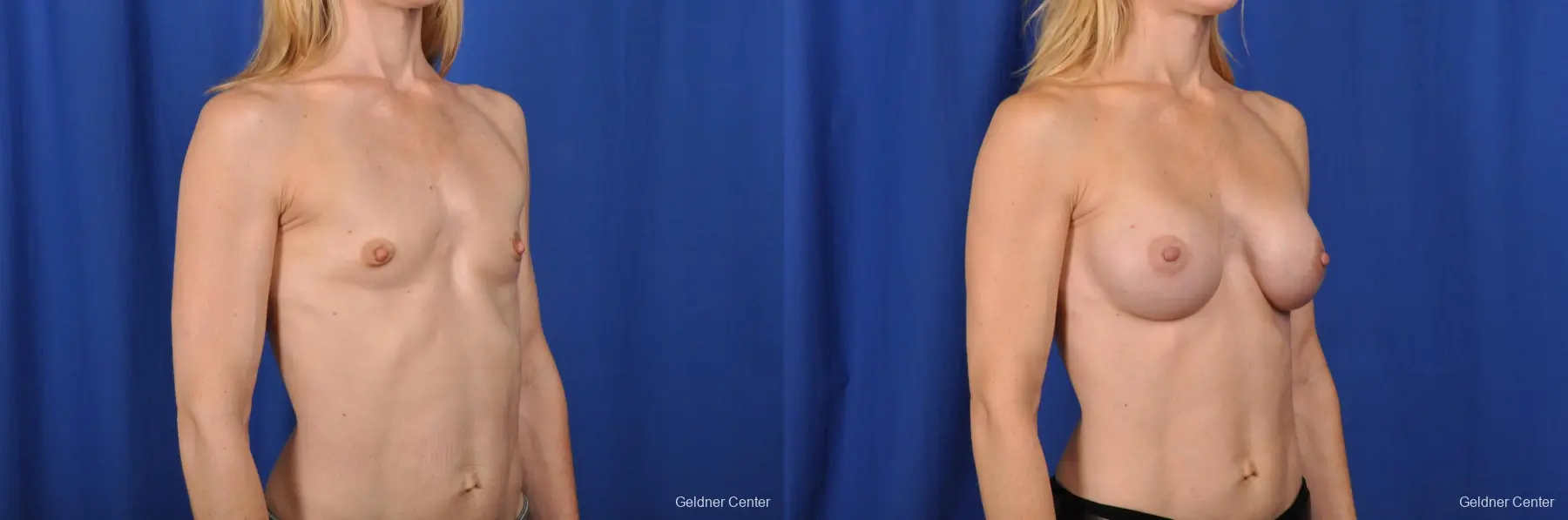 Chicago Breast Augmentation 2066 - Before and After 3