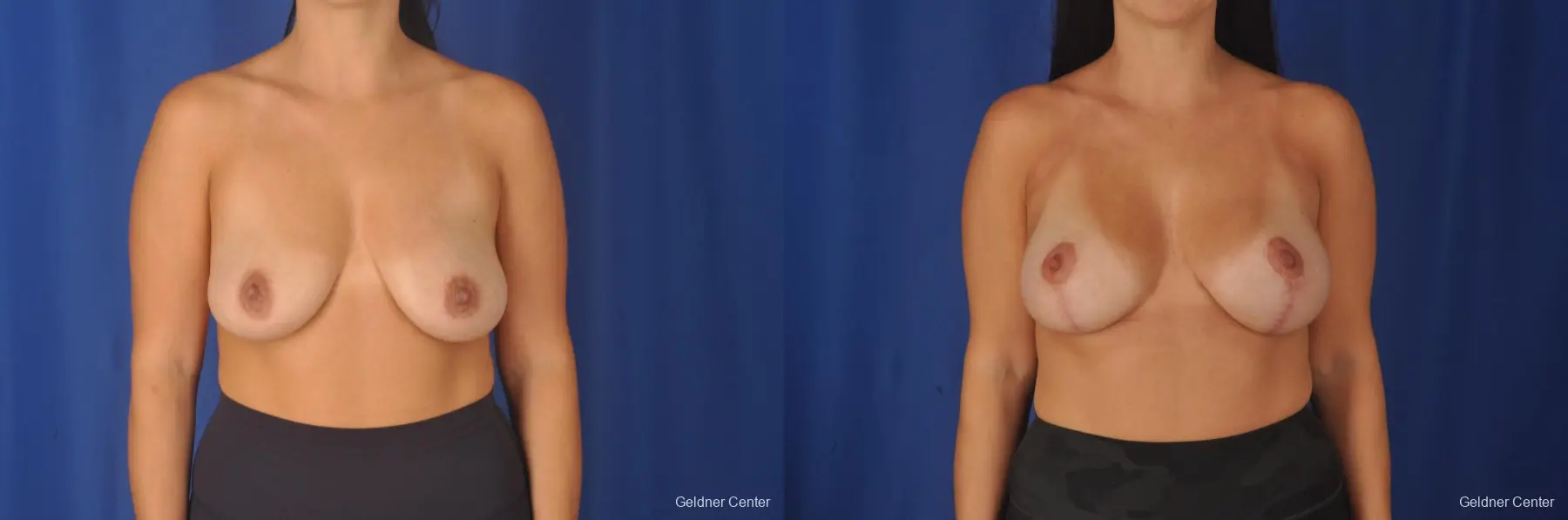 Breast Augmentation: Patient 79 - Before and After 1