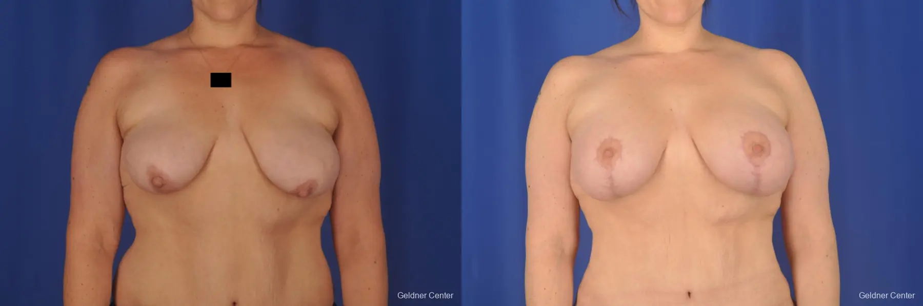 Breast Lift: Patient 18 - Before and After 1