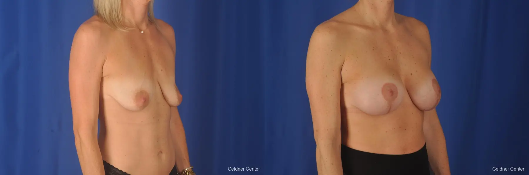 Breast Lift: Patient 20 - Before and After 3