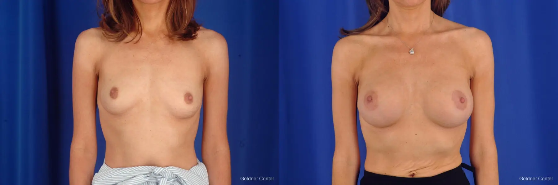 Breast Lift Chicago 2296 - Before and After