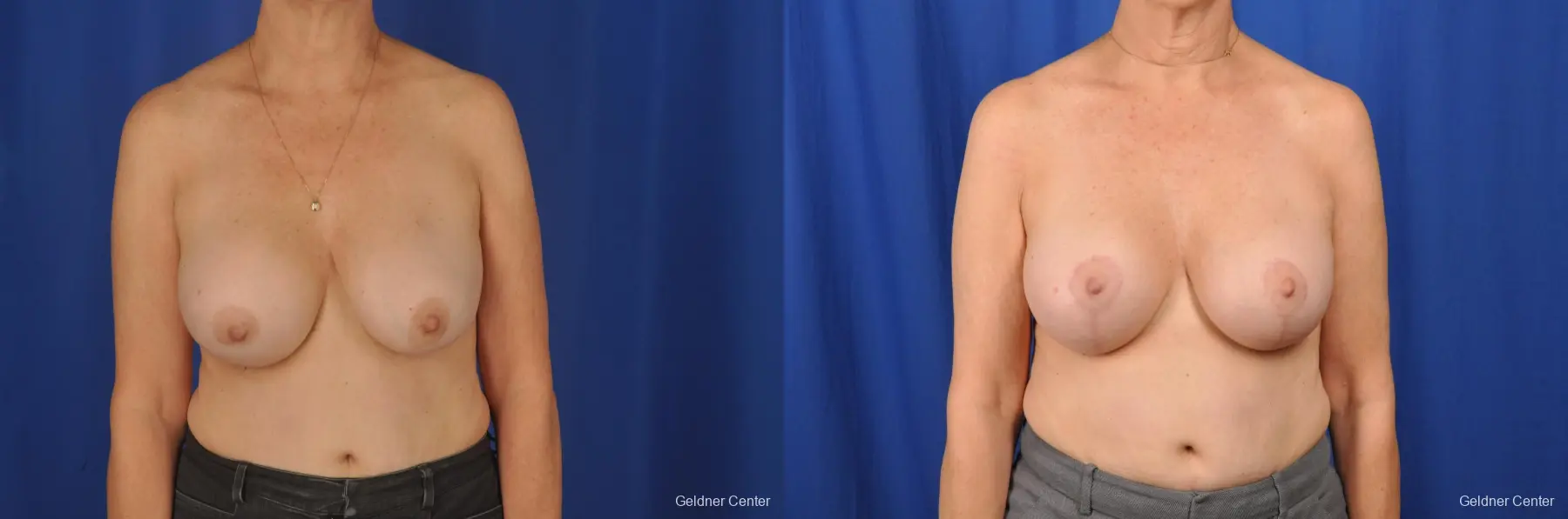 Breast Lift Hinsdale, Chicago 2058 - Before and After