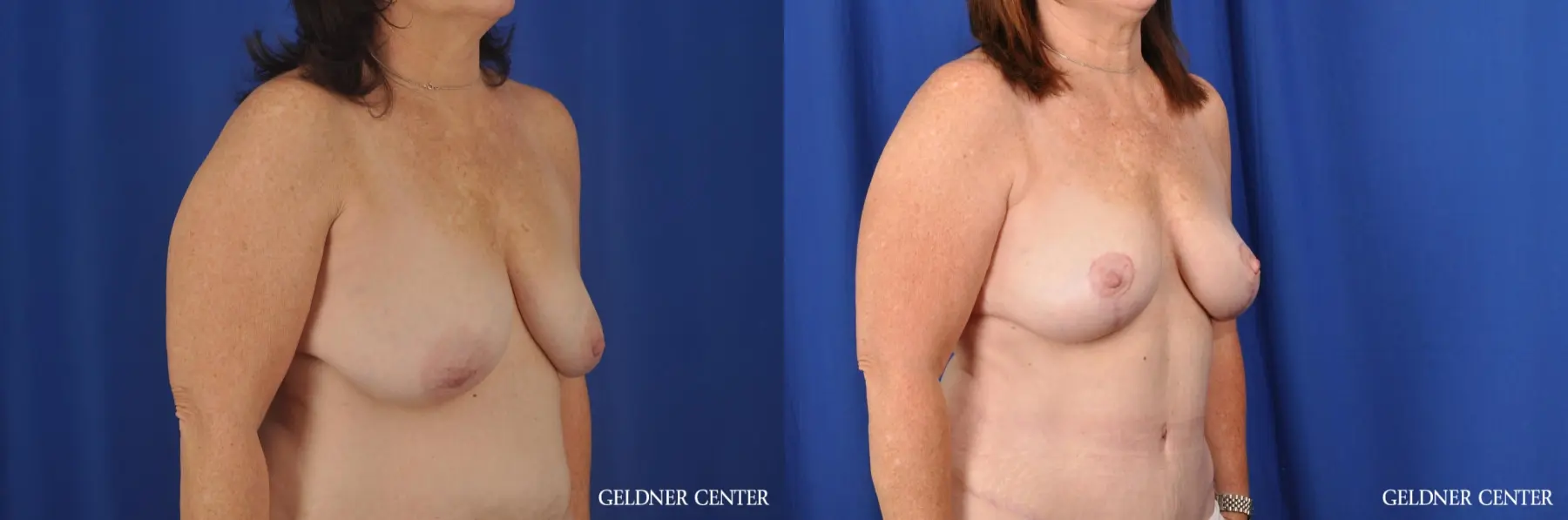 Breast Lift Hinsdale, Chicago 3232 - Before and After 3