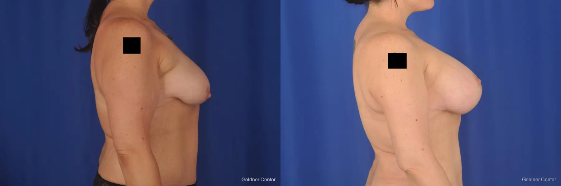 Breast Lift: Patient 18 - Before and After 3