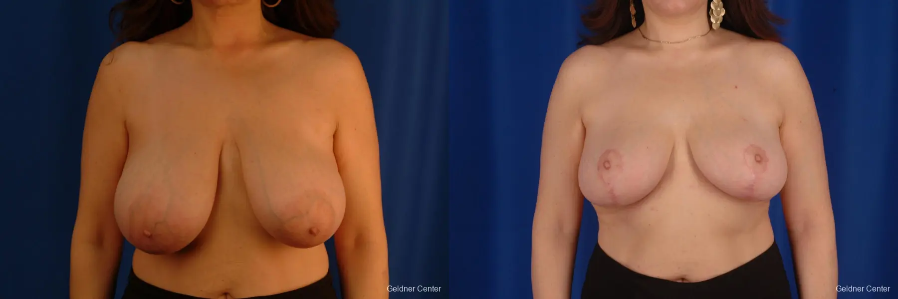 Breast Reduction Streeterville, Chicago 2289 - Before and After